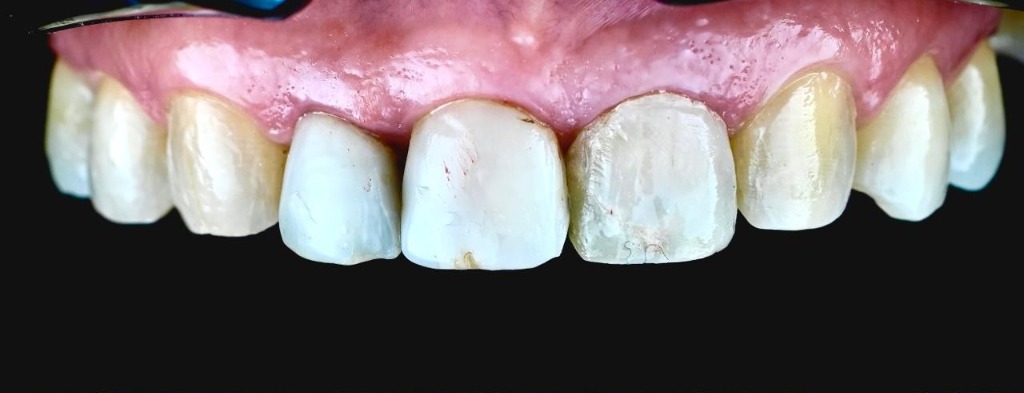 Before treatment 3