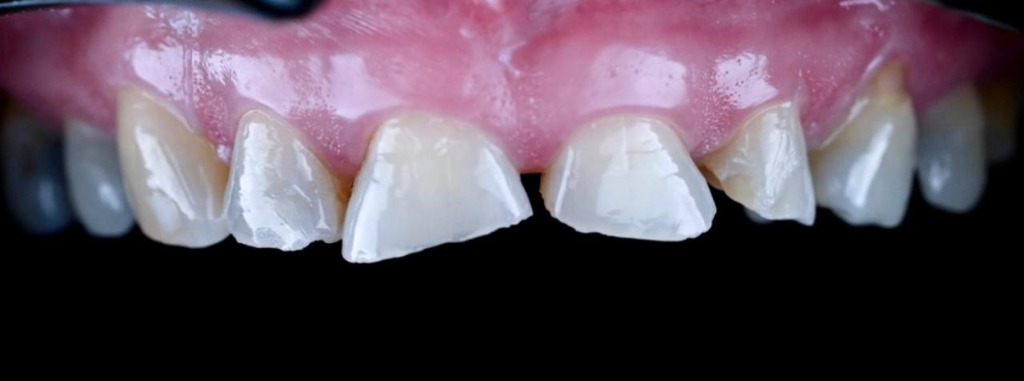 Before treatment 2