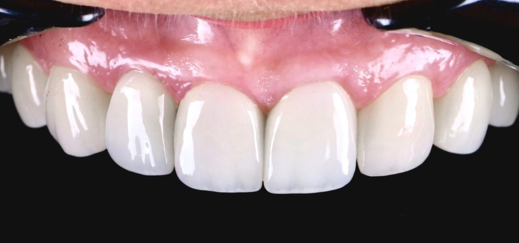 After treatment 3