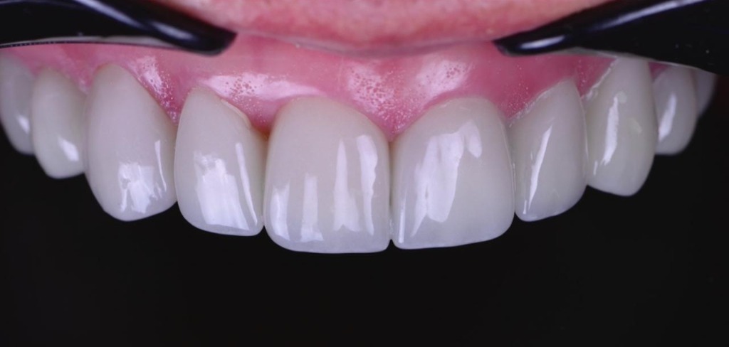 After treatment 2