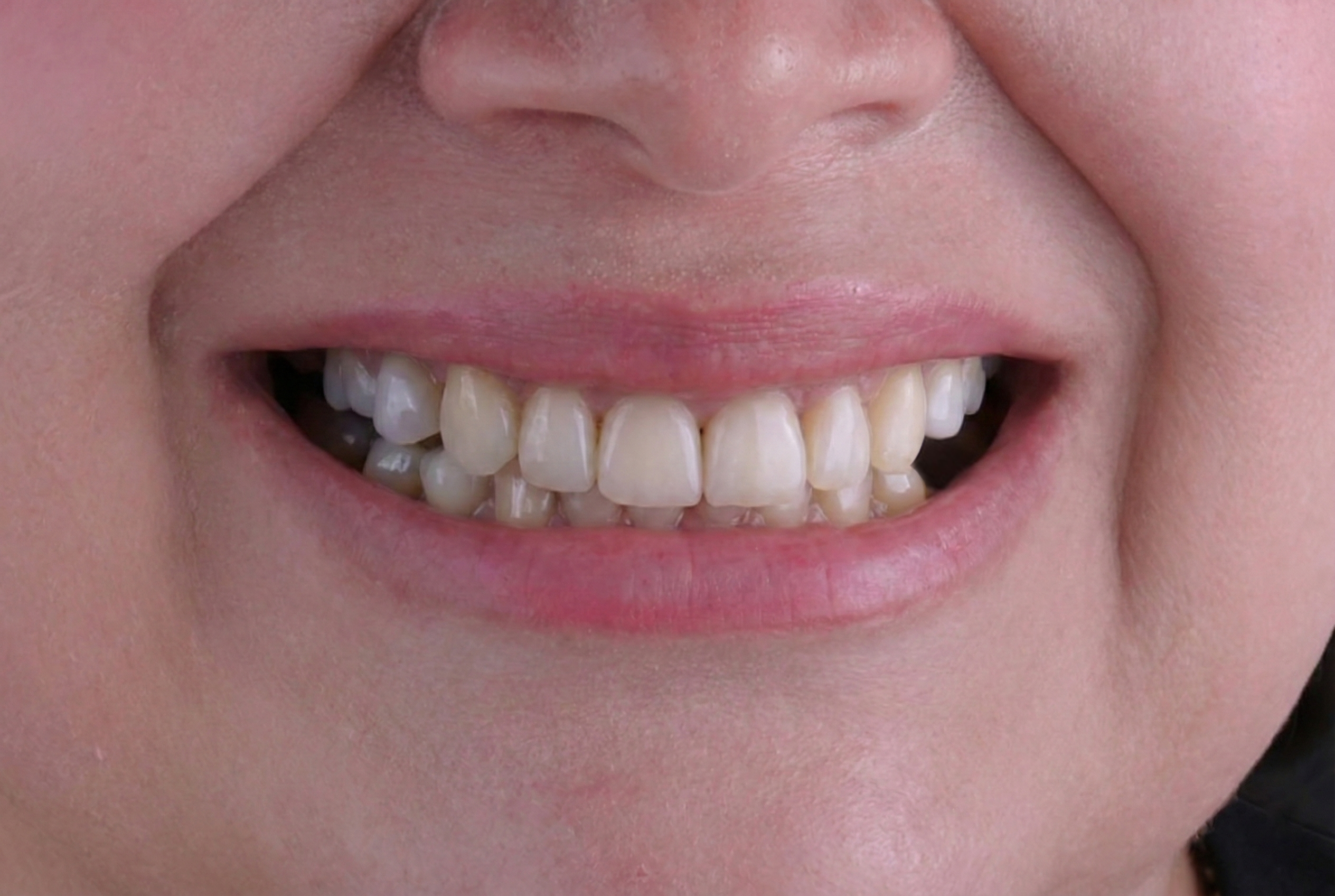 Antes