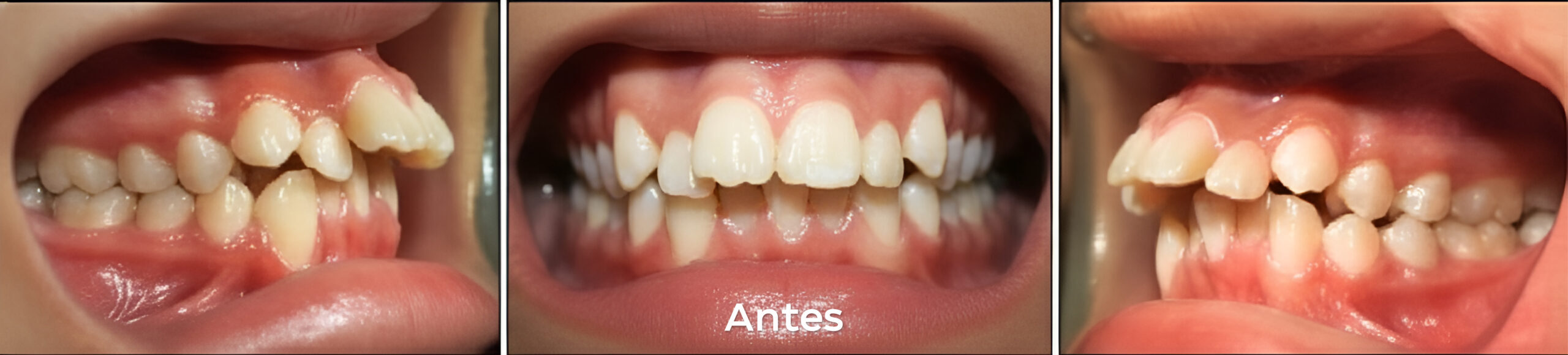 Antes