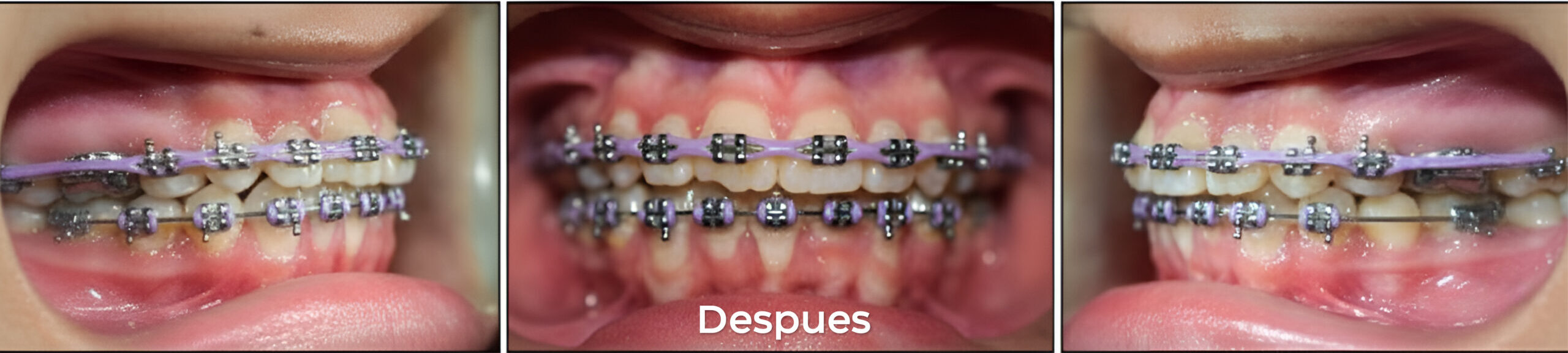 Despues